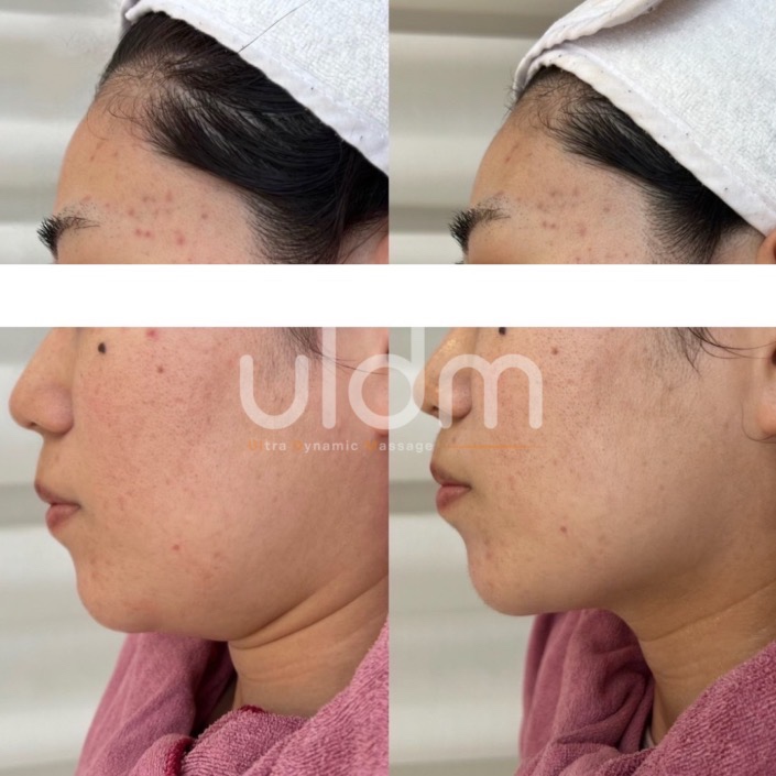 フラワーハーブピーリング