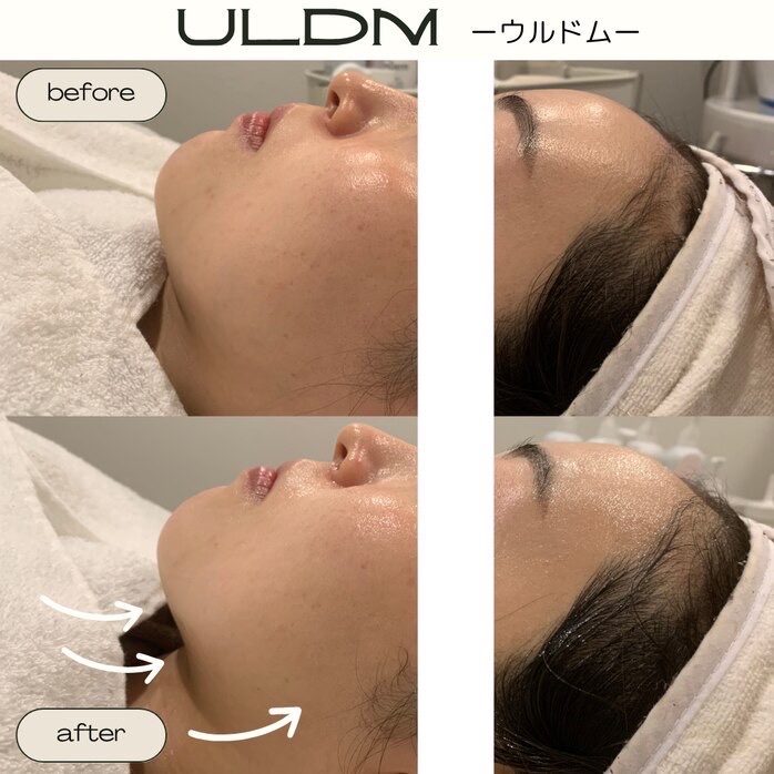 フラワーハーブピーリング